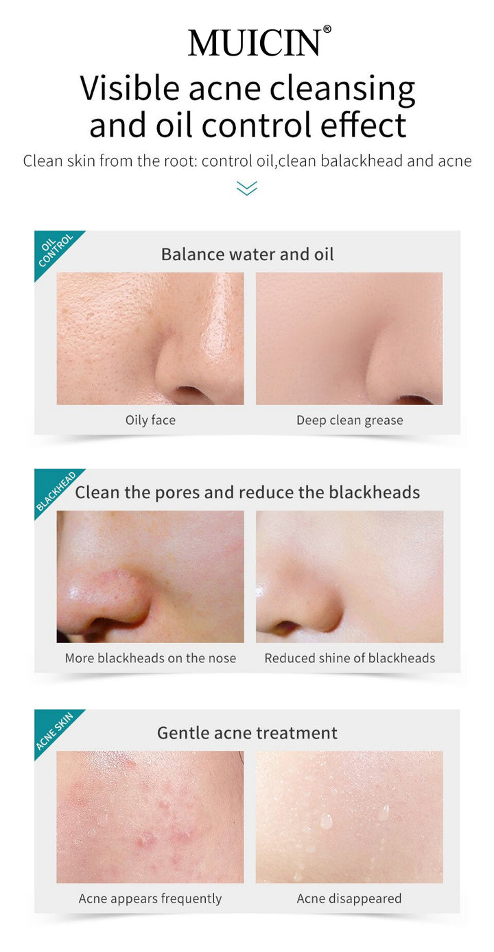 MUICIN - Tea Tree Bubble Foaming Facial Cleanser - 150ml Best Price in Pakistan